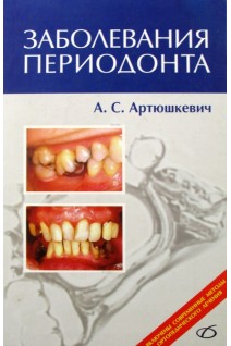 Заболевания периодонта. Артюшкевич