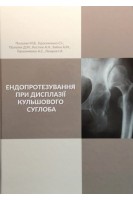 Ендопротезування при дисплазії кульшового суглоба. Полулях М.В.