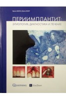 Периимплантит: Этиология диагностика и лечение. Франк Шварц Юрген Бекер