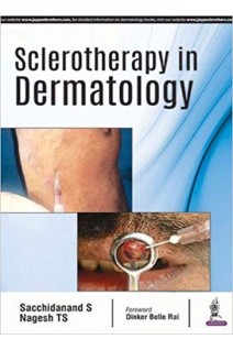 Sclerotherapy in Dermatology. Sacchidanand S Nagesh TS