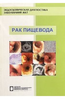 Рак пищевода. Эндоскопическая диагностика заболеваний ЖКТ: учебно-методическое пособие. Кузин М.Н. и др.