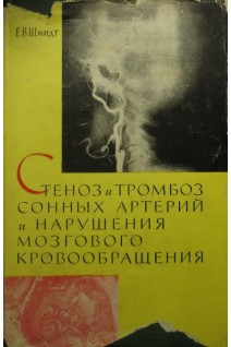 Стеноз и тромбоз сонных артерий и нарушения мозгового кровообращения (БУ). Шмидт Е.В.