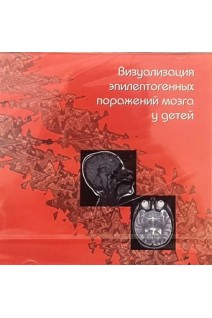 CD. Визуализация эпилептогенных поражений мозга у детей. под ред. А.А.Алиханова